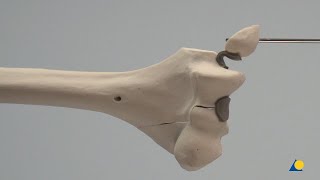 Humerus Distal—Lateral Condyle and Medial Epicondyle Fractures [upl. by Sitsuj]