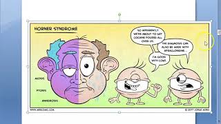 Ophthalmology Horner syndrome Horners Horners pupil triad oculo sympathetic paralysis Anisocoria [upl. by Adamson]