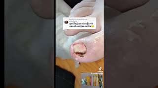 He stored too much cuticle under his toenail nail​​​ asmr fyp ear shorts viral wax [upl. by Llemmart]