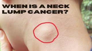 Could My Neck Lump Be Cancer Such as Lymphoma [upl. by Crowe]