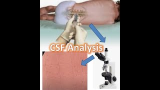 Plenty of neutrophils seen during CSF analysis [upl. by Jilly]