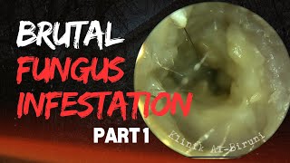 BRUTAL Fungus Infestation Due To Physician Mistake  PART 1 [upl. by Mart]