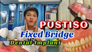 PUSTISO  Fixed  removable and Implant Pamalit sa nabunot na ngipin [upl. by Areid]