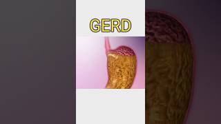 GERDmedicine healthtips healthcaresymptoms treatmentdoctorgerdgerdtreatment gerdanxiety [upl. by Muraida]