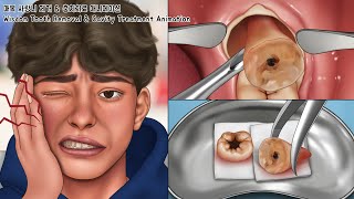 ASMR 매복 사랑니 제거 amp 충치치료 풀버전  치아미백  Wisdom Tooth amp Cavity Treatment Animation [upl. by Chaiken]