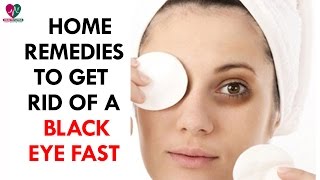 Home Remedies to Get Rid of a Black Eye Fast  Health Sutra [upl. by Agnizn891]