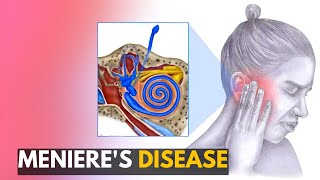 Menieres disease Everything You Need to Know [upl. by Onfroi]