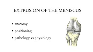 EXTRUSION OF THE MENISCUS  musculoskeletal ultrasound examination [upl. by Oinota]