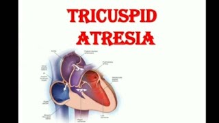 Tricuspid Atresia [upl. by Macnamara]