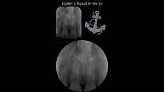 Anatomia radiográfica intrabucal  Região de incisivos centrais superiores  Parte 1 [upl. by Orecic]