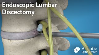 Endoscopic Lumbar Discectomy [upl. by Aholla]