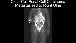 ClearCell Metastatic Renal Cell Carcinoma to Ulna [upl. by Lotta]