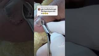 Huge ingrown toenail removal nail​​​ asmr fyp ear shorts viral wax [upl. by Aztin]