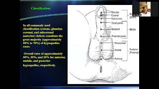 introduction to hypospadias أد عادل البكرى [upl. by Shira]