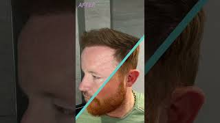 Hairline Restoration with FUE Hair Transplant  Longevita [upl. by Halfon]