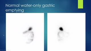 Nuclear medicine GI Scintigraphy [upl. by Pain]