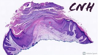 CNH Chondrodermatitis Nodularis Helicis Dermatology Mimic of Squamous Cell Carcinoma of Ear [upl. by Carbo]