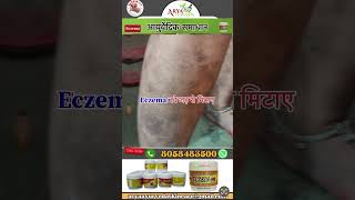 Eczema ayurvedic skin care [upl. by Virgilio]