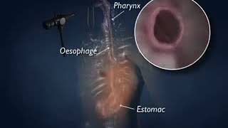 5 Endoscopie fibroscopie oeso gastro duodénale ou di [upl. by Ylrebmyk]