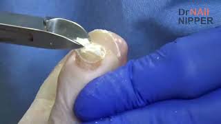 Dr Nail Nipper  NonIntro for March 22 [upl. by Keheley]