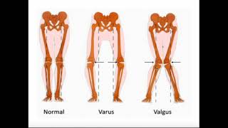 Valgus amp Varus Forces on the Knee  MCL vs LCL Injuries [upl. by Arrat]