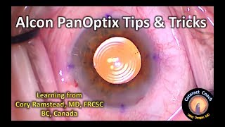 Alcon PanOptix Trifocal IOL Tips amp Tricks for Cataract Surgery [upl. by Ansilme]