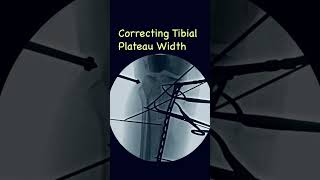 Correcting tibial plateau width in proximal tibia fractures ortho justortho trauma fracture [upl. by Wandy]