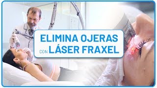 👀 Cómo quitar las OJERAS en solo 5 minutos con LÁSER TRATAMIENTO DEFINITIVO [upl. by Ollehcram]