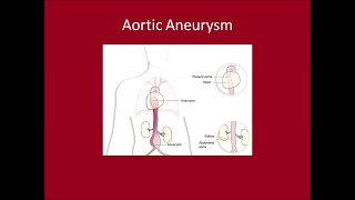 Management of Aortic Aneurysms [upl. by Ahsercal]