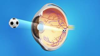 Cataract Surgery with a Multifocal Lens [upl. by Elagibba]