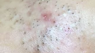 AWESOME FACIAL BLACKHEADS REMOVAL  Suri Job 146 [upl. by Lazaruk188]