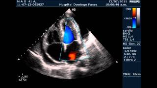 Pericarditis AgudaTaponamiento Cardiaco Dr Pedro Guillermo Bustos 12 Julio 2011 [upl. by Pavlish399]