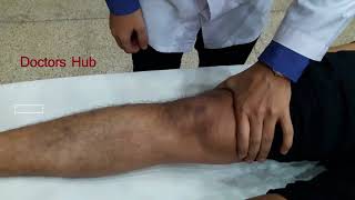 Patellar Tap Test  Clinical Methods [upl. by Harol470]