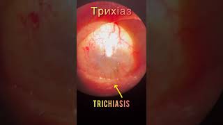 Corneal opacification and trichiasis  Помутніня рогівки і трихіаз  Помутнение роговицы и трихиаз [upl. by Ayle]