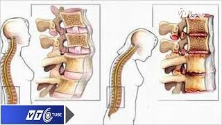 Bệnh loãng xương Âm thầm và nguy hiểm  VTC [upl. by Dominus5]