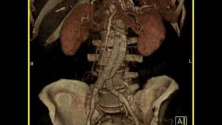 Aortic Stent Graft 3D imaging of a vascular stent in satisfactory position [upl. by Winchell]