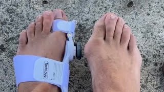 Do BUNION CORRECTORS Work PART 2 shorts [upl. by Virgil]