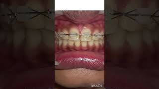 Closing midline diastema with ceramic braces shorts [upl. by Eladal]