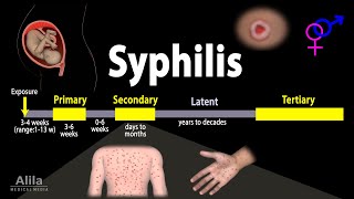 Syphilis  Pathophysiology Diagnosis and Treatments Animation [upl. by Anert105]