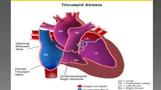 2  4 TRICUSPID ATRESIA [upl. by Leile]