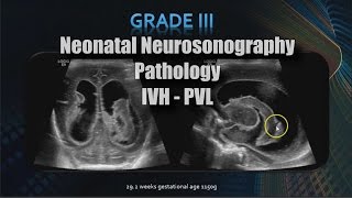 Neonatal Neurosonography  Pathology  IVH  PVL [upl. by Leticia]