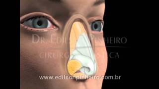 Rinoplastia Fechada  Cirurgia Plástica em 3D  Antes e Depois  Plástica do Nariz [upl. by Notsae]