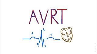 Atrioventricular Reentrant Tachycardia AVRT SVT ECGTUTORIAL cardiology medicalstudents AVNRT [upl. by Issiah732]