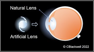 Intraocular Lenses 2 Vision After Surgery [upl. by Ahsinoj78]