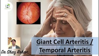 Giant Cell Arteritis GCA  Temporal Arteritis  All You Need to Know I Dr Shaz Rehan 2022 [upl. by Ahcsap991]