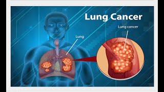 Lung cancer complete care amp Treatment lungcancersymptoms lungcancersymptoms lungcancertreatment [upl. by Cogn]