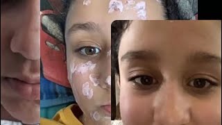 My chicken pox experience  day 1 to day 21  last day  Aileenkamal [upl. by Seuqramed993]