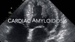 Cardiac Amyloidosis case No2 [upl. by Ttennaej]