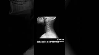 Cervical spine trauma radiologiest learningradiology medicalconsultation [upl. by Marl]