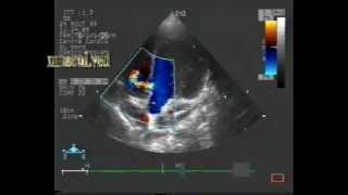 muscular ventricular septal defectVSD [upl. by Teressa]